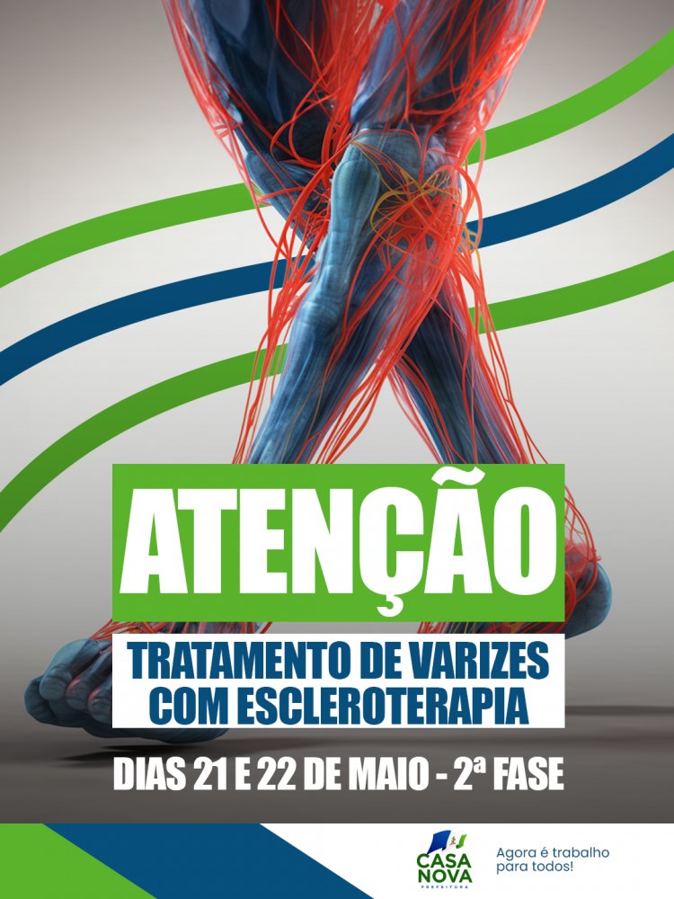 Saúde que transforma vidas: sucesso do tratamento de varizes garante nova etapa em Casa Nova