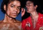 Vitiligo: entre desinformação e preconceito, condição ainda desafia inclusão