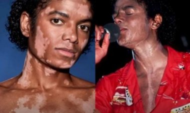 Vitiligo: entre desinformação e preconceito, condição ainda desafia inclusão