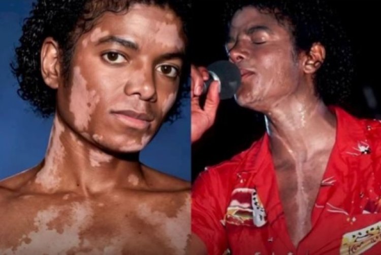 Vitiligo: entre desinformação e preconceito, condição ainda desafia inclusão